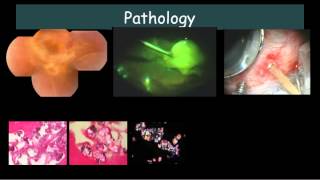 Bilateral Exudative retinal detachment with subretinal exudates Dr E M Dodds [upl. by Glantz135]