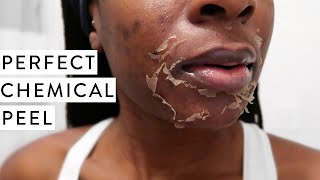 I TRIED A CHEMICAL PEEL  Full Process Before and After Dark Marks amp Acne Scars [upl. by Mable]