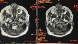 Neurofibromatosis tipo 2 [upl. by Spracklen]