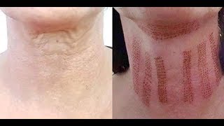 My neck lift non surgical [upl. by Hovey]