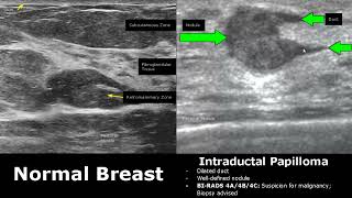 Breast Ultrasound Normal Vs Abnormal Image Appearances Comparison  BIRADS Classification USG [upl. by Dierdre807]