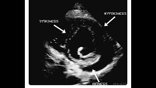 Hypokinesia Dyskinesia and Akinesia in a Single Echocardiography Frame [upl. by Ellett]