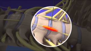 Stellate Ganglion Block [upl. by Marcy]