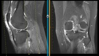 How to diagnose a meniscus tear [upl. by Beata]