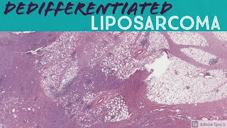 Dedifferentiated liposarcoma with heterologous osteosarcoma component [upl. by Ayocal]