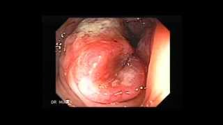 Colonoscopy of Colon Cancer [upl. by Nyssa141]