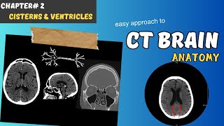 CT BRAIN Chapter 2 Cisterns amp Ventricles [upl. by Gauldin779]