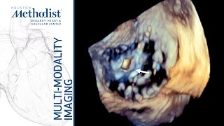 New Frontiers in Structural Heart Disease Imaging amp Role of 3D Echo Nadeen Faza MD Nov 26 2019 [upl. by Mallina]