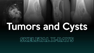 Tumors and Cysts Skeletal Xrays [upl. by Teeter954]