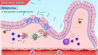 Ulcerative Colitis Animation  Etiology Clinical features Pathophysiology Diagnosis Treatment [upl. by Aihsekyw]