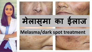 काले दाग का ईलाज  Melasma dark spots  pigmentation Causes amp Treatment Hindi  Dr Aanchal Panth [upl. by Maximilian]