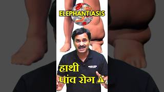 Elephantiasis Filariasis  हाथी पांव रोग 😰 disease neetpreparation neetexam [upl. by Luas309]