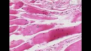 Histopathology Skeletal muscle  Muscular dystrophy [upl. by Aleik335]