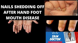 Nails shedding off after hand foot mouth diseaseonychomadesissymptoms of hand foot mouth disease [upl. by Nepil]