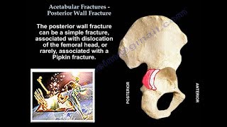 Acetabulum Fracture Posterior Wall Fracture  Everything You Need To Know  Dr Nabil Ebraheim [upl. by Osugi]