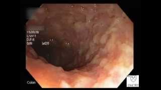 Clostridium Difficile Colitis [upl. by Ennahteb]