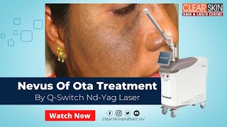 Nevus Of Ota Treatment by Q Switch Nd YAG Laser Helios  Nevus of OTA  Birth Mark  Laser Treatment [upl. by Engedi]