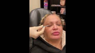 Nurse Heather Explain PRP Injections Under the Eye [upl. by Emorej801]