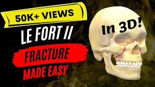 ORAL SURGERY  Le Fort II Fracture in 3D [upl. by Erait842]