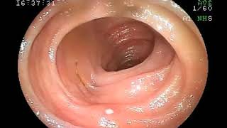 25042019 Aphthous Ulcers in Terminal Ileum Encountered During Colonoscopy [upl. by Neehsar]