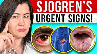 10 Signs of Sjogrens Syndrome  a very complex autoimmune disease [upl. by Ainaj214]