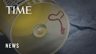 How Australian Doctors Found a 3InchLong Live Worm in a Woman’s Brain [upl. by Appleton238]