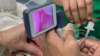 A preterm neonate is intubated using a video laryngoscope [upl. by Assiron341]