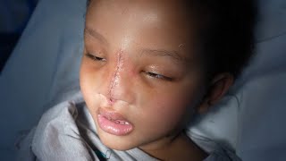 Suture Removal for Child after Tumor on Face [upl. by Moreno777]