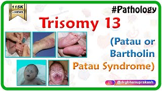 Trisomy 13 Patau or BartholinPatau syndrome  Causes  Diagnosis  Treatment [upl. by Jerusalem]