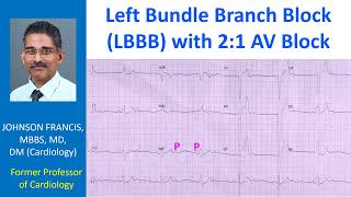 Left Bundle Branch Block LBBB with 21 AV Block [upl. by Arie]