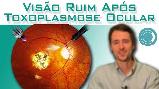 Toxoplasmose Ocular  visão embaçada após o tratamento [upl. by Phelgon]