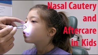 Pediatric Nosebleed Cauterization and Aftercare [upl. by Ahsieym]