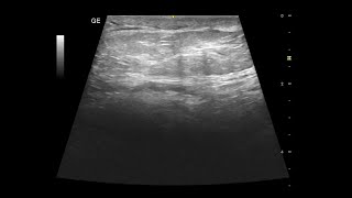 Spermatic Cord Lipoma  Ultrasound Case  GU [upl. by Oel]