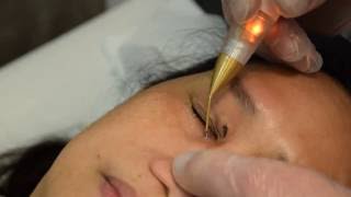 Eliminar Xantelasma con Jett Plasma Lift Medical [upl. by Dupuis]