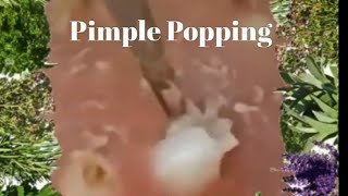 Pimple amp Blackheads Popping  50 [upl. by Clarine874]