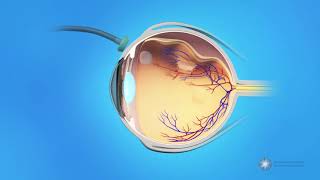 Vitrectomy Surgery for Detached Retina [upl. by Cutcliffe]