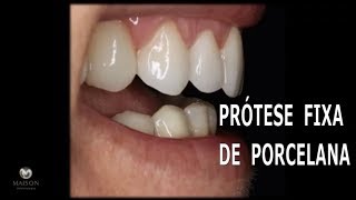 Prótese fixa de Porcelana com Implantes [upl. by Ellenod347]