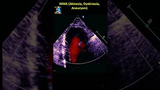 WMA Akinesia Dyskinesia Aneurysm [upl. by Ennayelhsa]