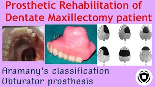 Prosthetic rehabilitation of Dentate Maxillectomy patientPart 1 [upl. by Anec]