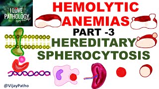 Hemolytic Anemias Part 3 HEREDITARY SPHEROCYTOSIS [upl. by Llewxam]