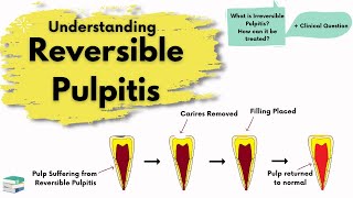 Reversible Pulpitis  Causes Diagnosis and Treatment  Endodontics [upl. by Kubetz647]