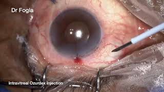 Intravitreal Ozurdex Injection [upl. by Ytak849]