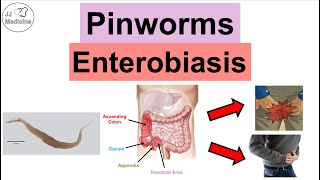 Pinworms Enterobiasis  Infection Transmission Symptoms Diagnosis Treatment [upl. by Kucik]