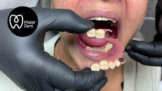 ¡¡ Prótesis dental de 3 DIENTES Y SIN PALADAR  😱😱 misterdent [upl. by Libb]