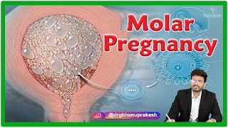 Molar Pregnancy  Causes Clinical manifestations Diagnosis and Treatment [upl. by Goodrow]