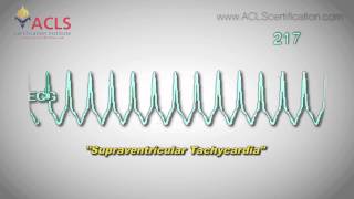 Supraventricular Tachycardia SVT by ACLS Certification Institute [upl. by Grigson837]