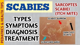 Scabies Classic Crusted Nodular Scabies Symptoms Diagnosis and Treatment  Itch Mite [upl. by Tacklind257]