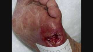 Diabetic Foot Care [upl. by Aerdma]