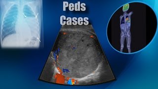 Cases  Chest  Pleuropulmonary Blastoma III [upl. by Elletnohs]