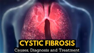 CYSTIC FIBROSIS Causes Signs and Symptoms Diagnosis and Treatment [upl. by Syla]